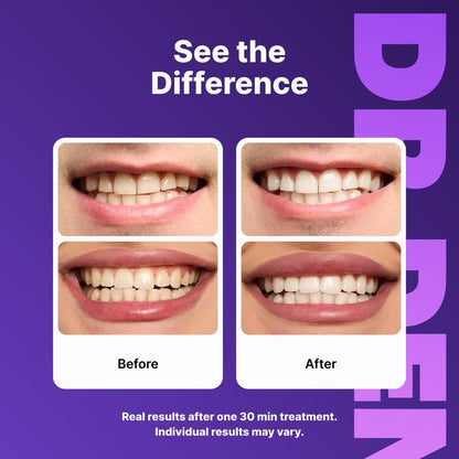 Purple Teeth Whitening Strips - 7/21 Sessions - Non-Sensitive & Peroxide-Free