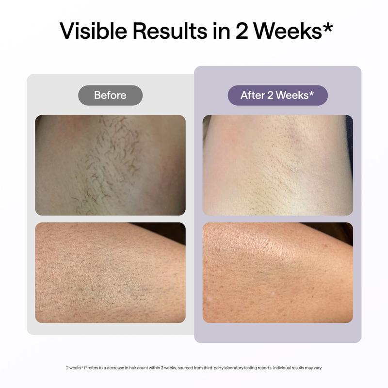 Laser Hair Removal Device with Ice-Cooling Technology, Dual Lights Skin Sensor & SHR Mode